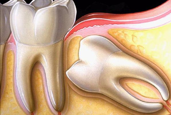 Зуб мудрости: чем опасен период его формирования и прорезывания