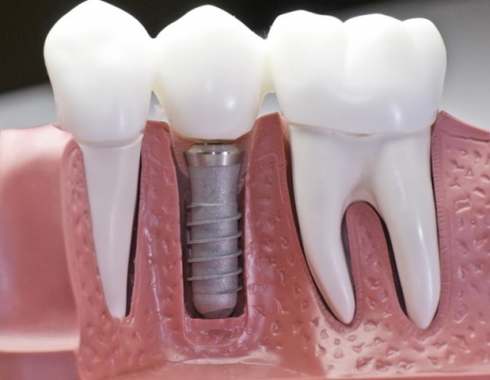 Имплантация зубов при различных стоматологических заболеваниях