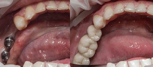 Имплантация и протезирование 3-х зубов