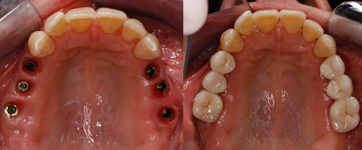 Имплантация зубов жевательной группы
