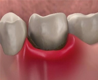 Воспаление десен под зубным протезом - Стоматология Aliksma