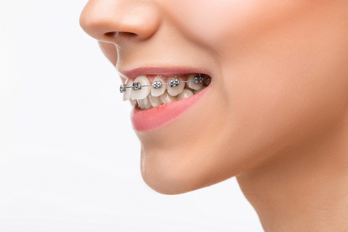 Как брекет-система двигает зубы