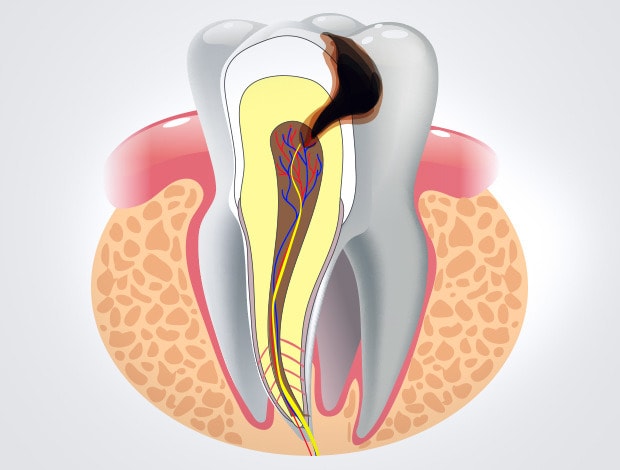 Что делать, когда болит зуб: постановка диагноза и лечение пульпита