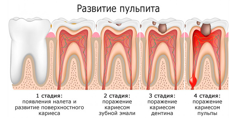 Пульпит зуба: лечение и цена