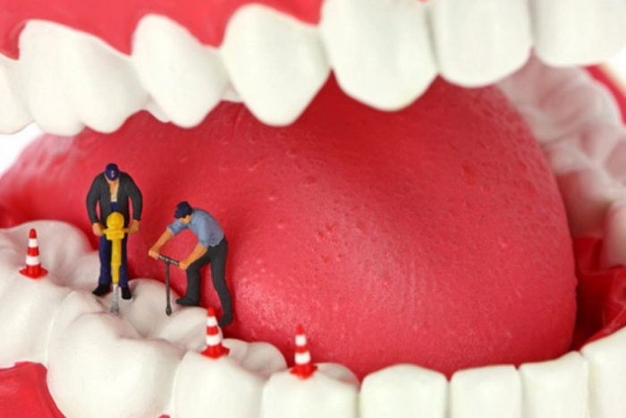 Лечение кисты канала зуба качественно