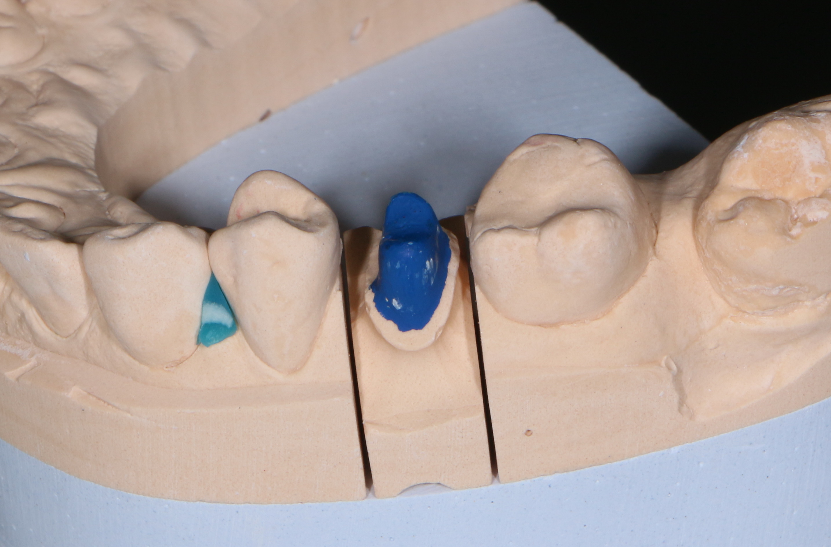 Эффективное восстановление зубов протезированием под вкладку