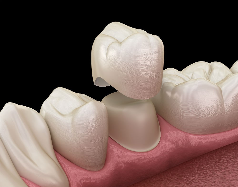 Эффективное восстановление зубов протезированием под вкладку