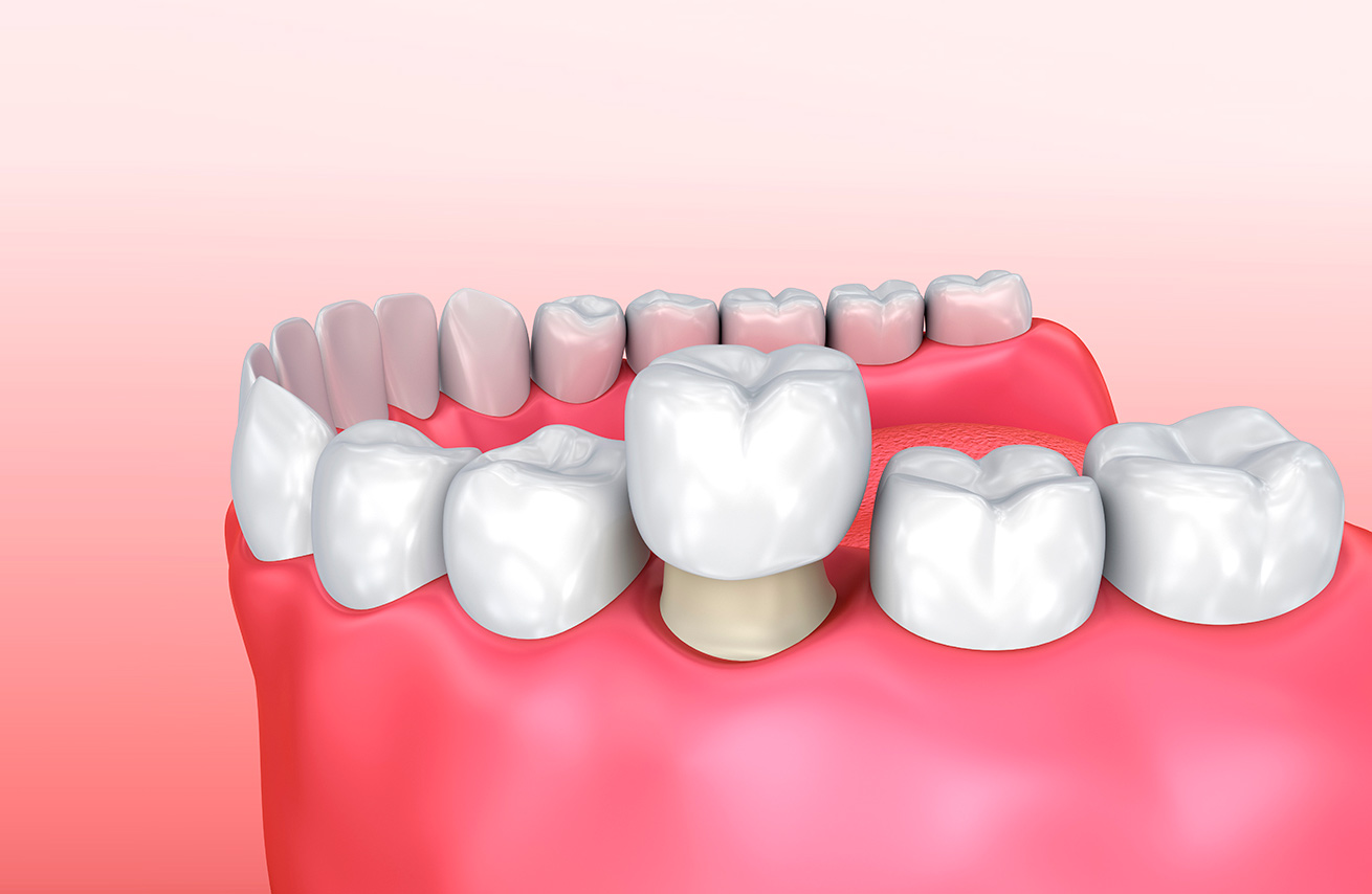 Протезирование зубов культевой вкладкой: что это такое и в чем преимущество методики