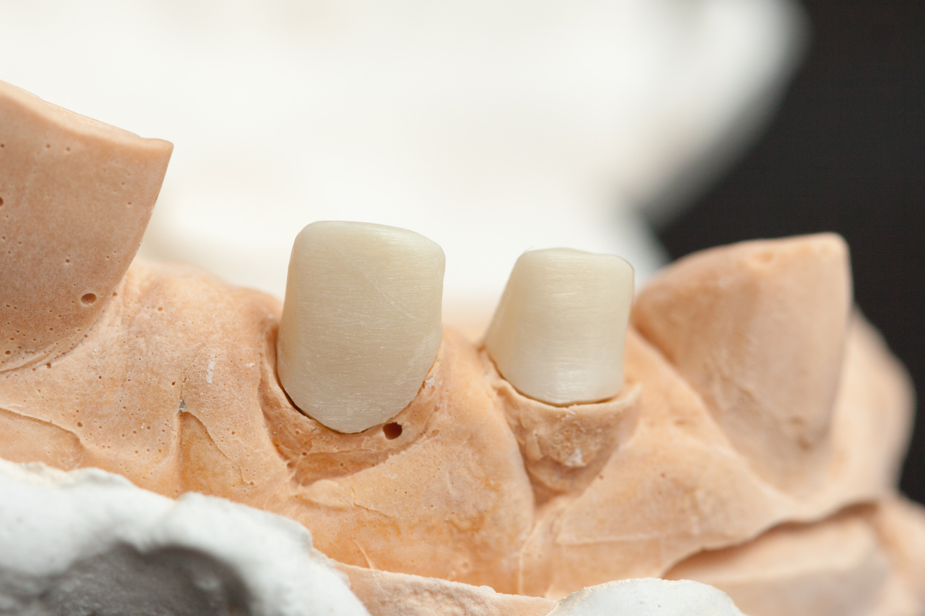 Протезирование зубов культевой вкладкой: что это такое и в чем преимущество методики