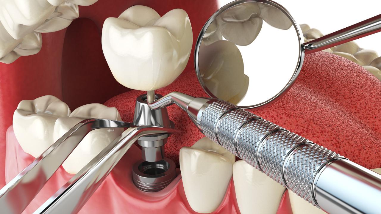 Имплантация зубов – где, сколько стоит и какую технологию выбрать