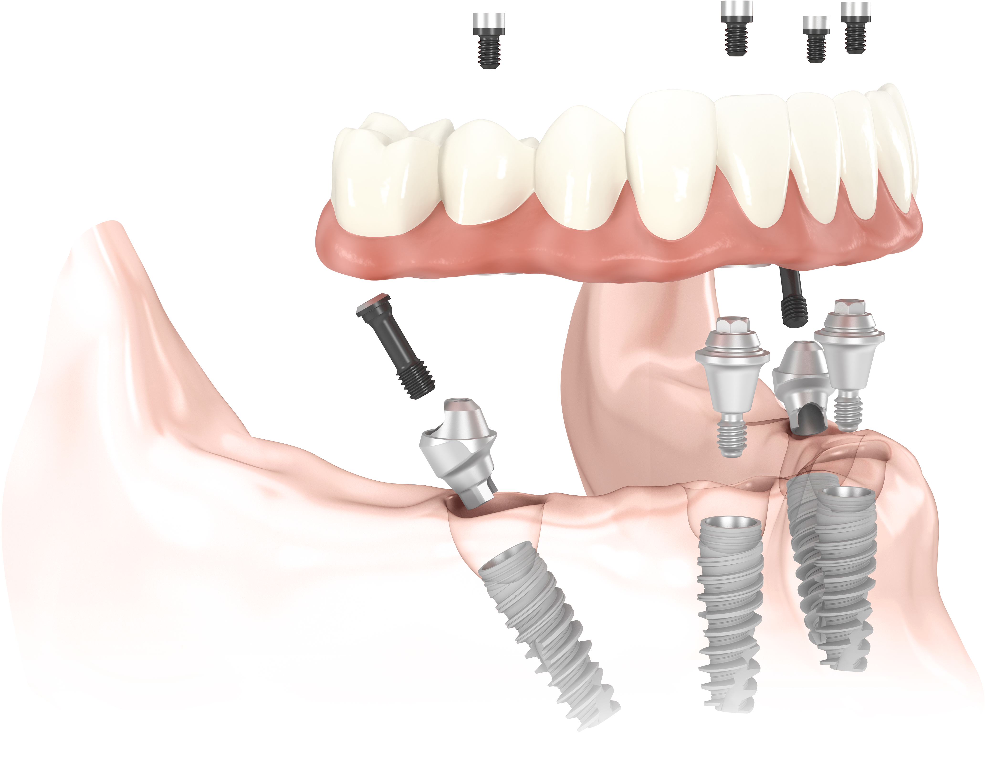Имплантация зубов – где, сколько стоит и какую технологию выбрать