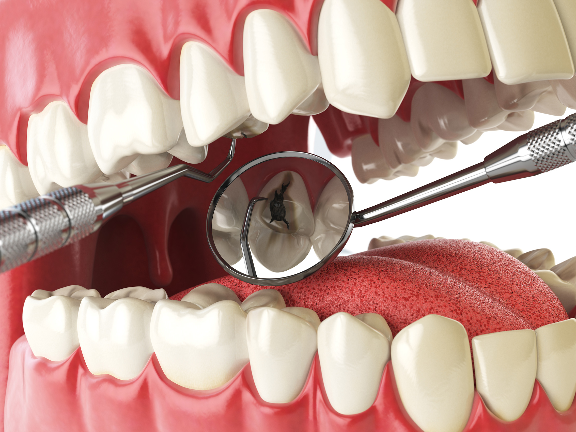 Лечение зубов и чистка каналов – этапы процесса
