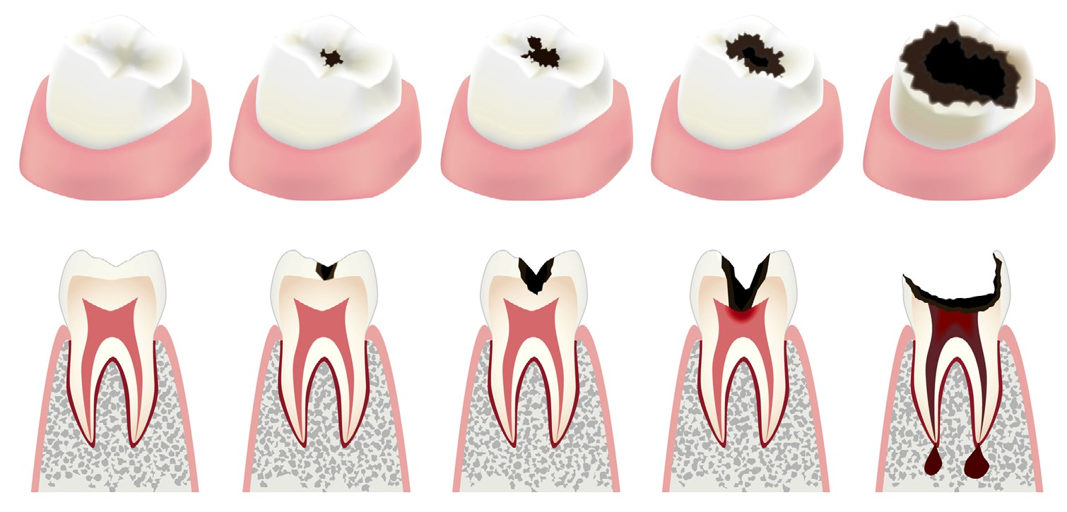 Лечение зубов при перфорации каналов без удаления