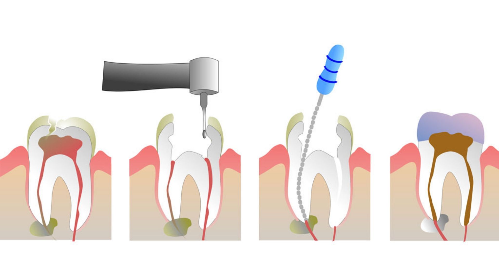 Лечение зубов при перфорации каналов без удаления