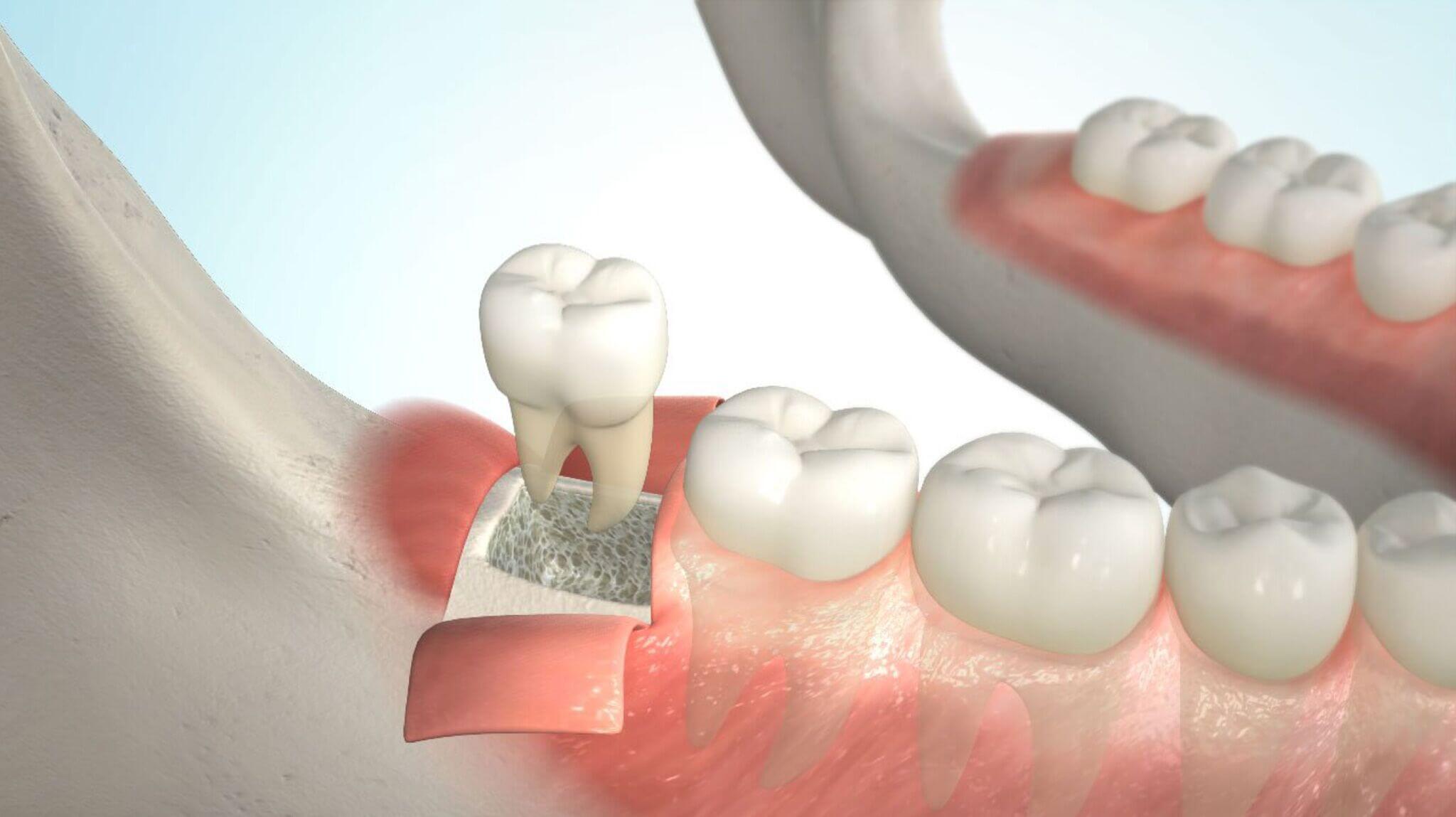 Процедура удаления ретинированного или дистопированного зуба: основные этапы