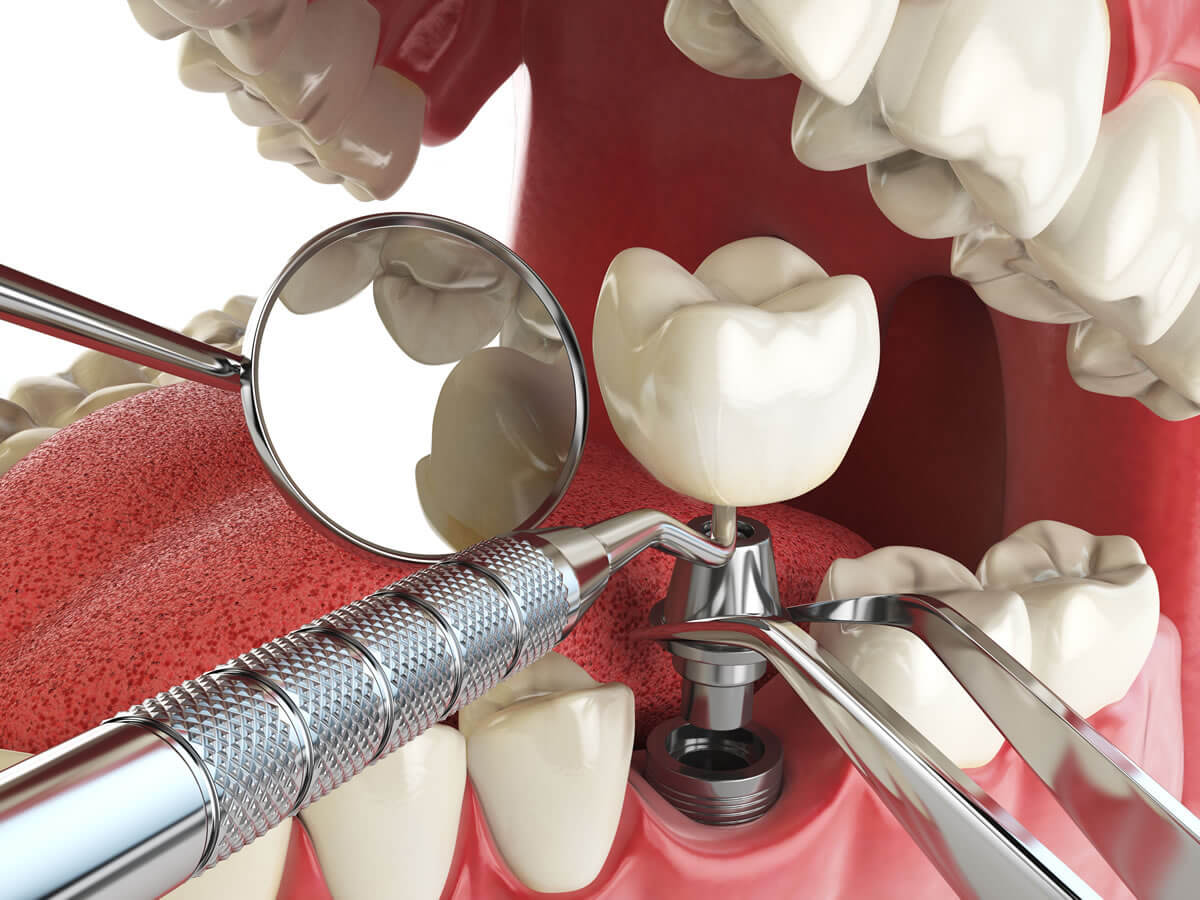 Клиника все свои стоматология цены импланты