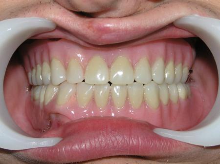 Преимущества протезирования без имплантов при полном отсутствии зубов