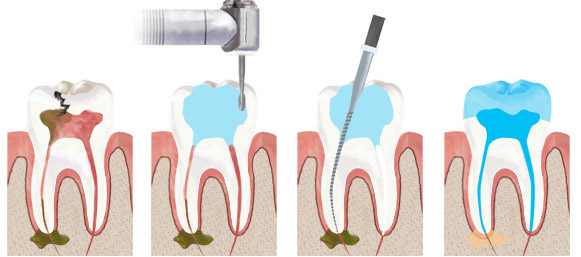 Лечение зубов с труднопроходимыми каналами