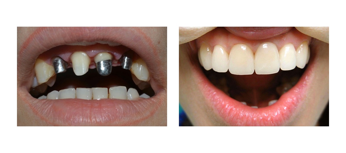 Недорогое протезирование зубов металлокерамикой – ремонт коронки 