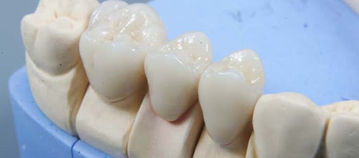 Недорогое протезирование зубов металлокерамикой в Москве фото 2