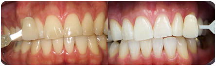 Плюсы и минусы чистки зубов ультразвуком
