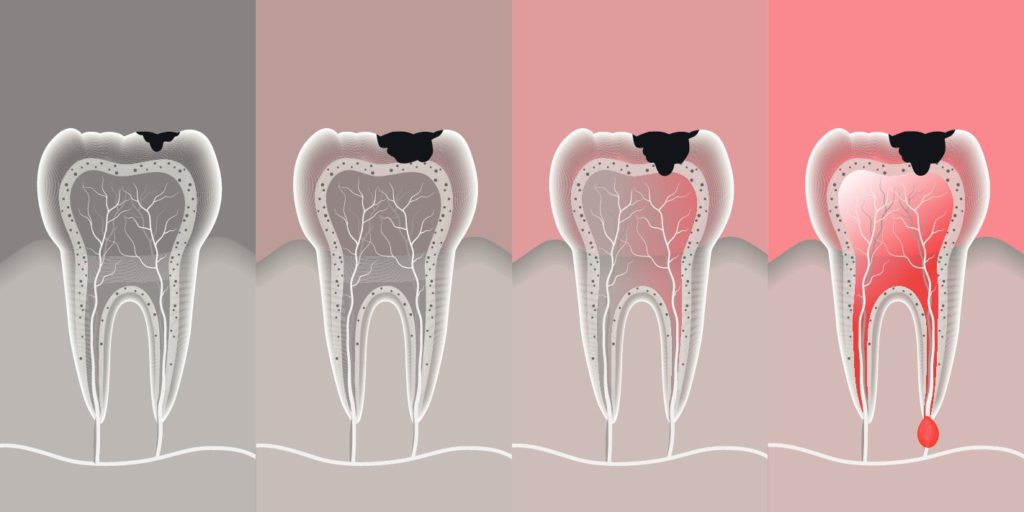 Методы лечения гранулемы при перфорации канала зуба