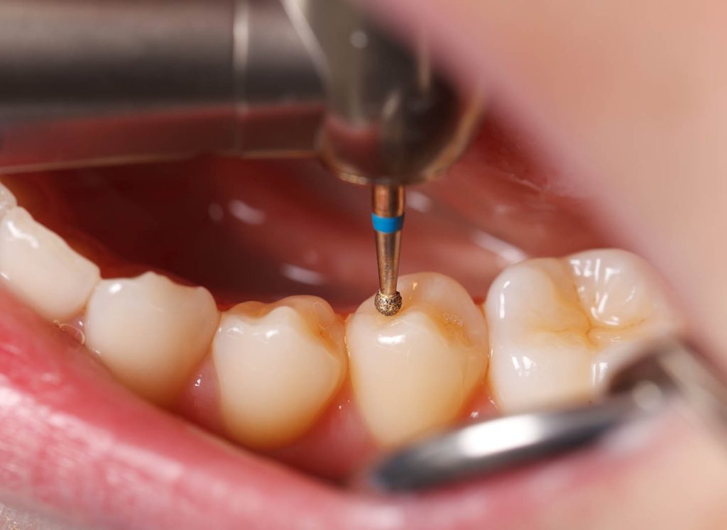 Методики лечения воспаления каналов зуба под пломбой