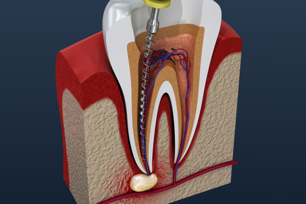 Как проводится лечение канала зуба пастой