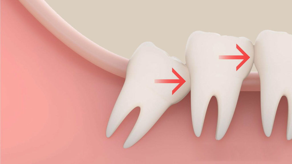 Сложное удаление ретинированного зуба мудрости: назначение, этапы и особенности операции