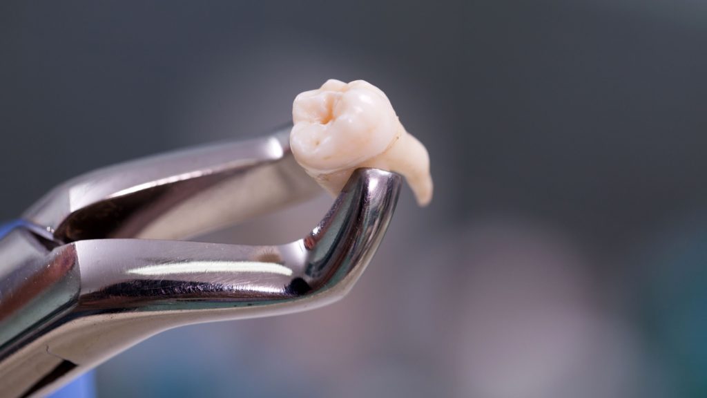Удаление ретинированного дистопированного зуба мудрости: цены, сложности и типы операций