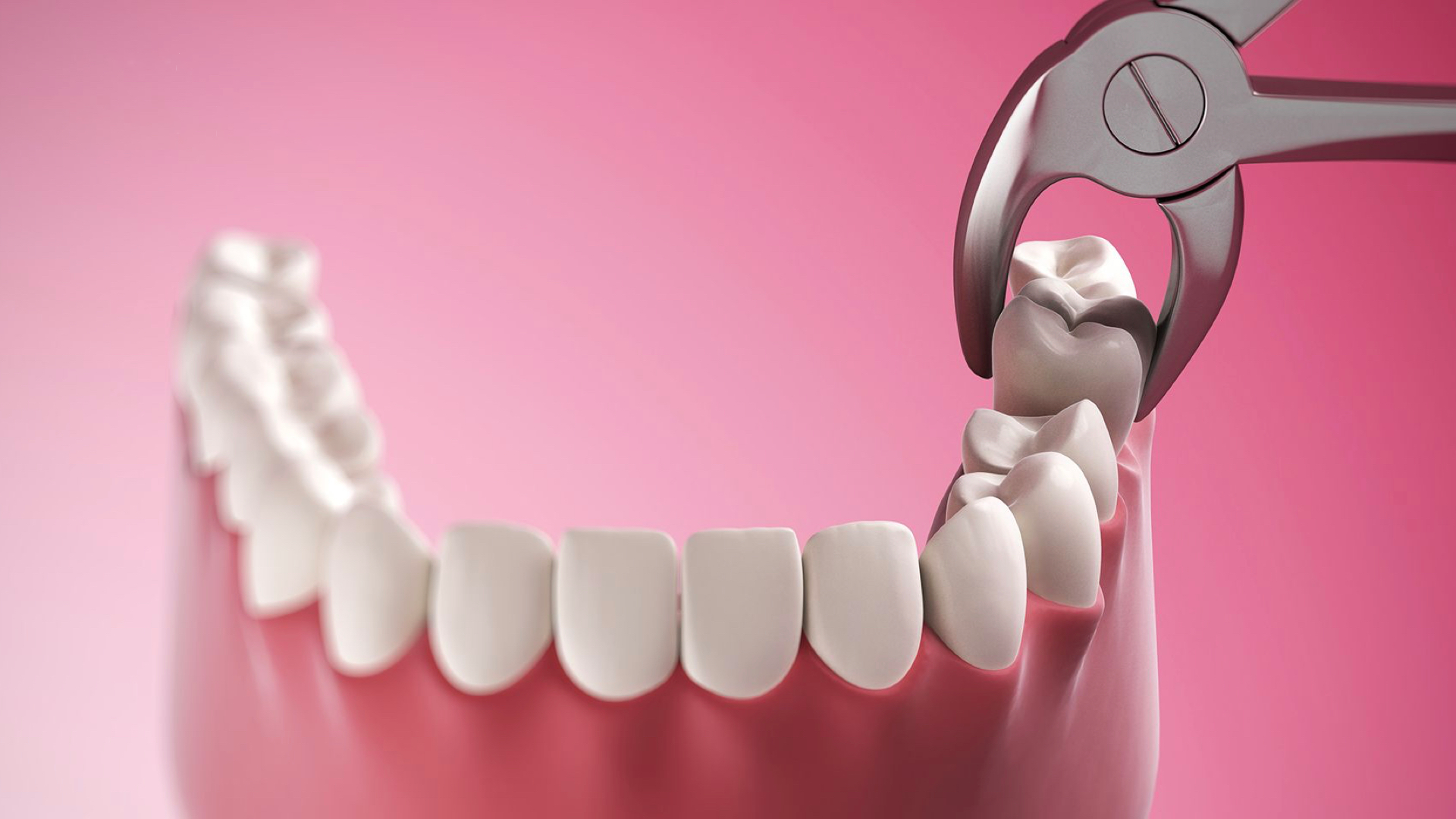 Удаление зуба мудрости: показания, подготовка и реабилитация