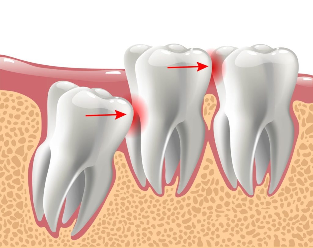 Этапы и причины сложного удаления зуба мудрости