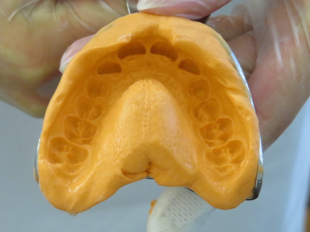 Материал для снятия слепков зубов: что используют современные стоматологи