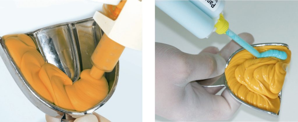 Как проводится процедура снятия слепков зубов под металлокерамику