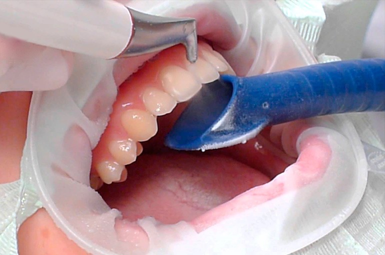 Процедура удаления верхнего ретированного зуба