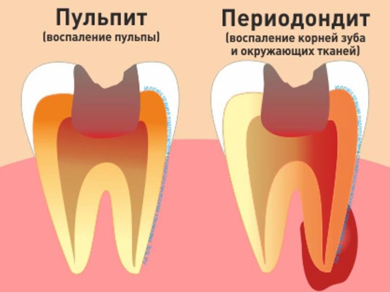 Причины воспаления пульпы зуба
