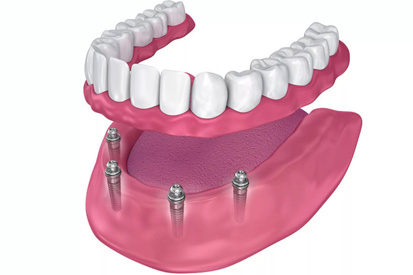 Какие осложнения могут возникнуть при протезировании верхних зубов на 4 имплантах