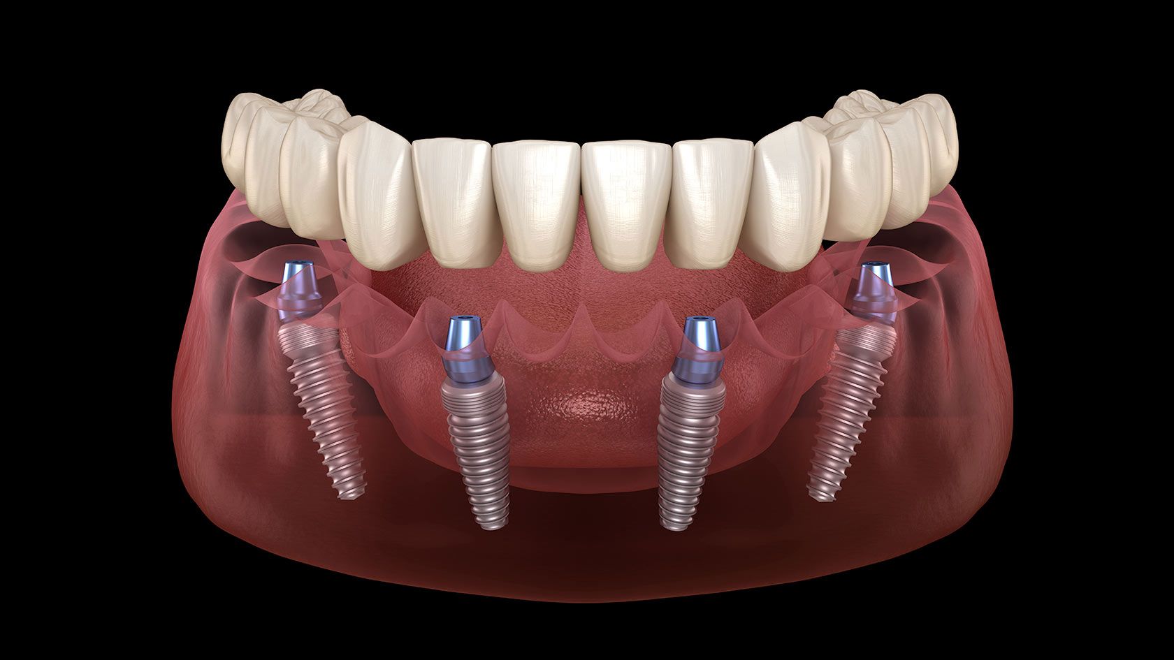 Технология протезирования зубов ALL on 4 – что это такое