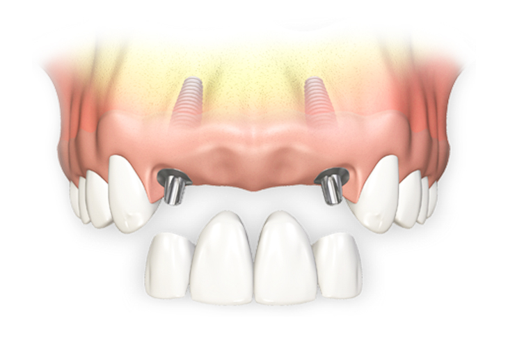 Способы протезирования 4 передних зубов