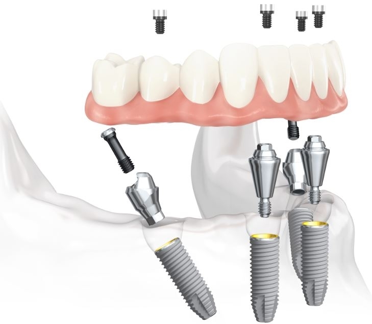 Как формируются цены на протезирование зубов на 4 имплантах