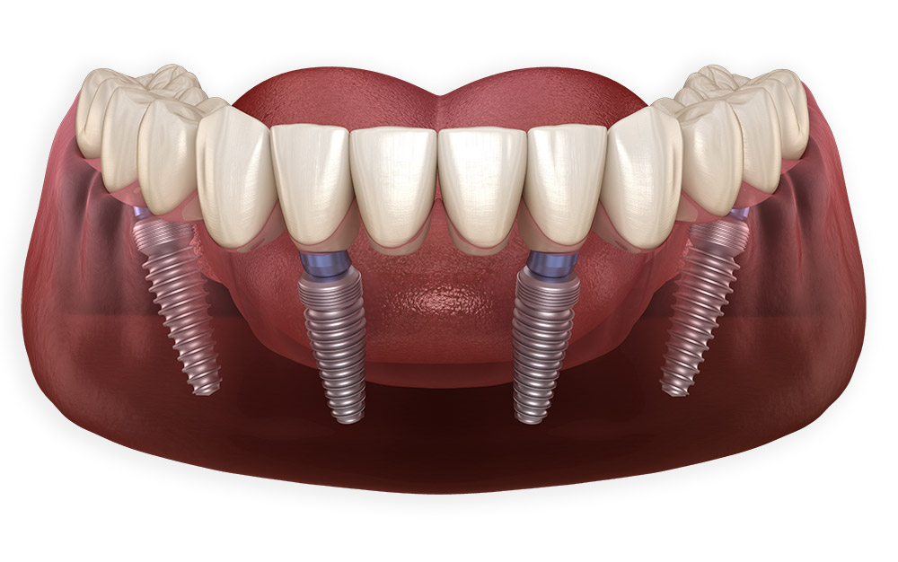 Протезирование зубов на 4 имплантах: этапы, особенности и преимущества процедуры