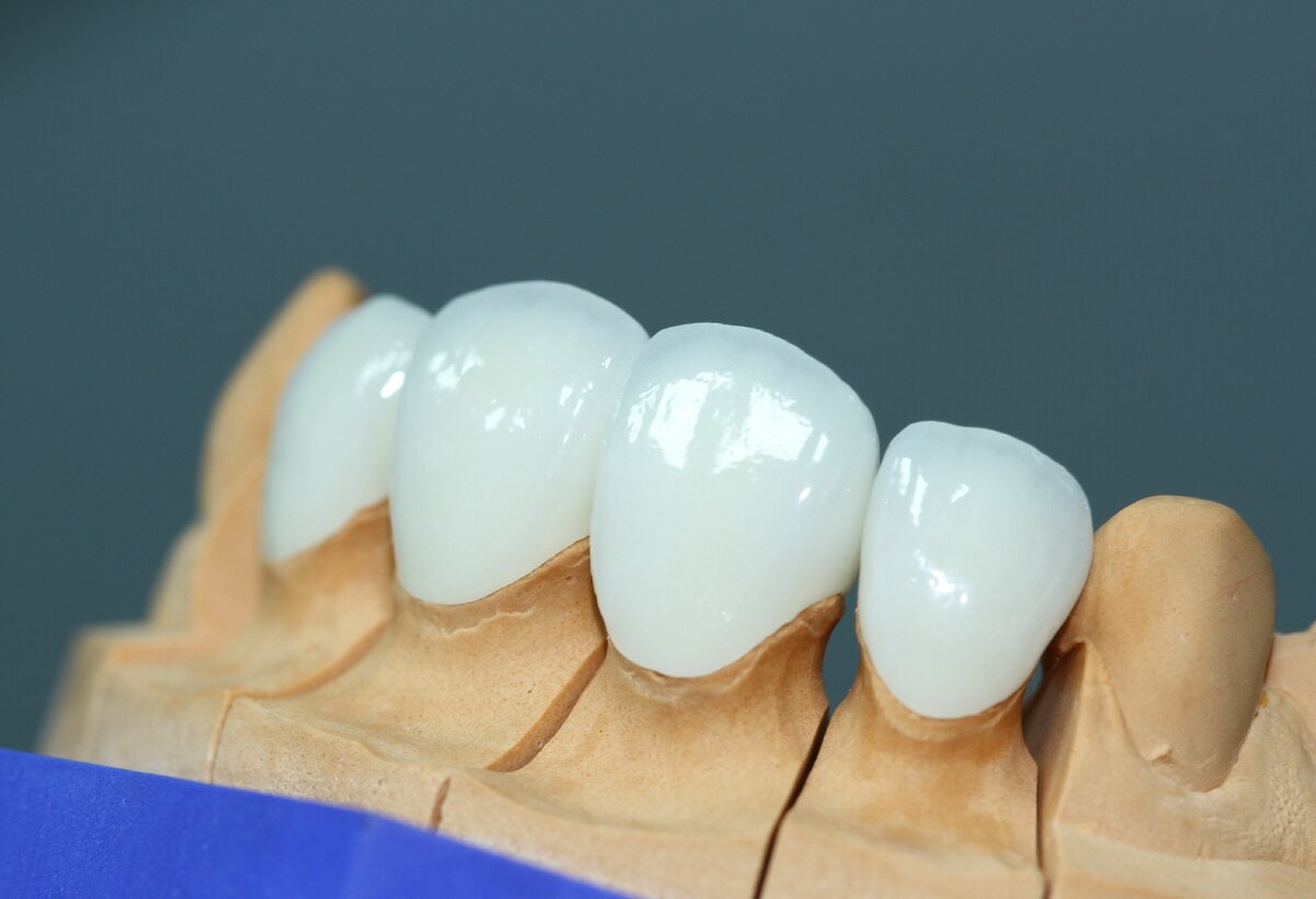 Способы протезирования 4 передних зубов