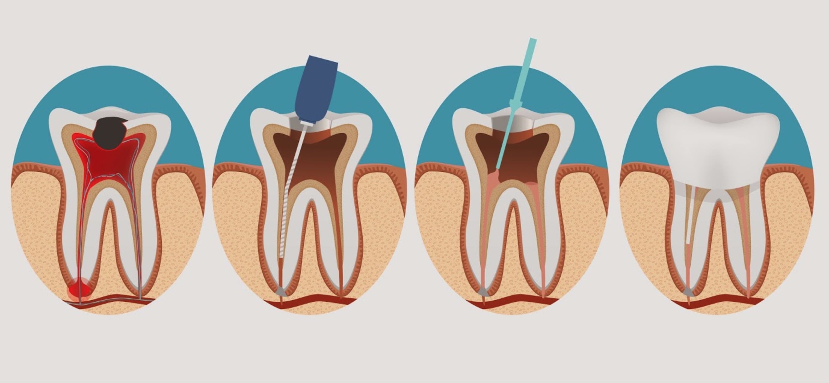 Как формируются цены на лечение корневых каналов зубов