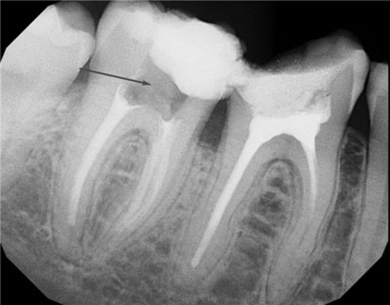 Лечение канала зуба под пломбой при воспалении или повреждении эмали