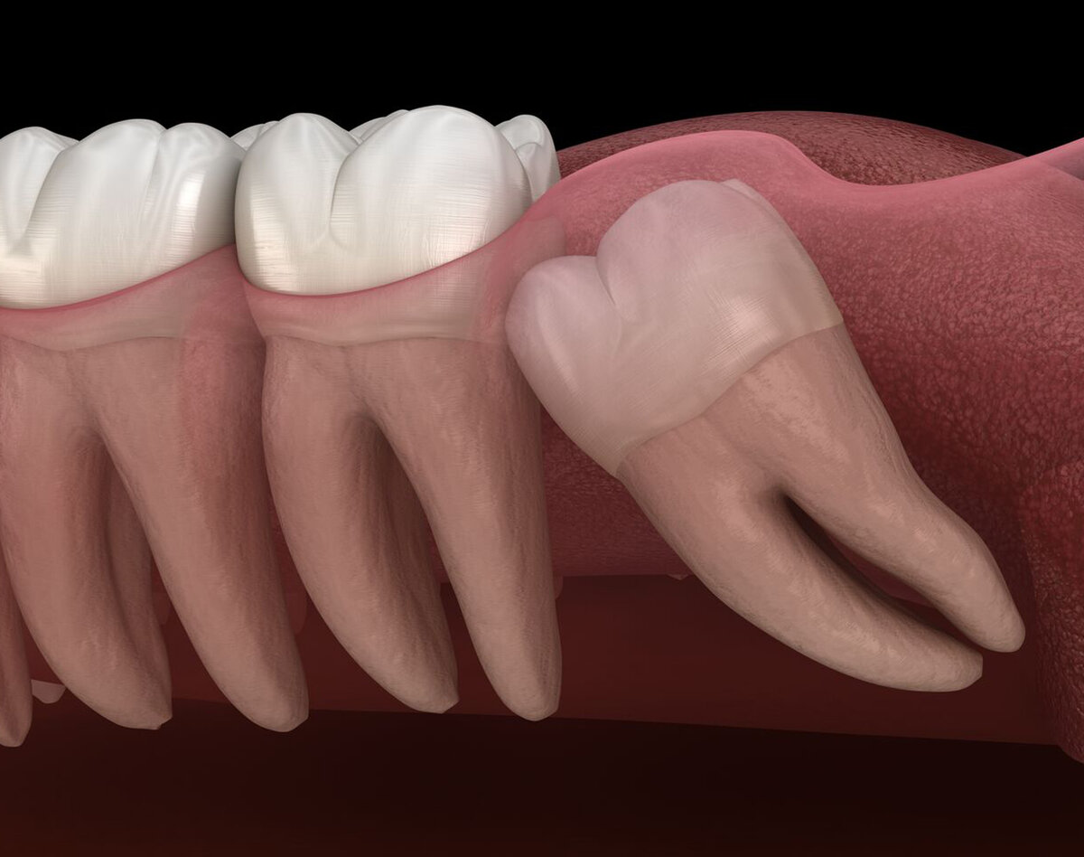 Что делать, если болит зуб мудрости – удаление или лечение?