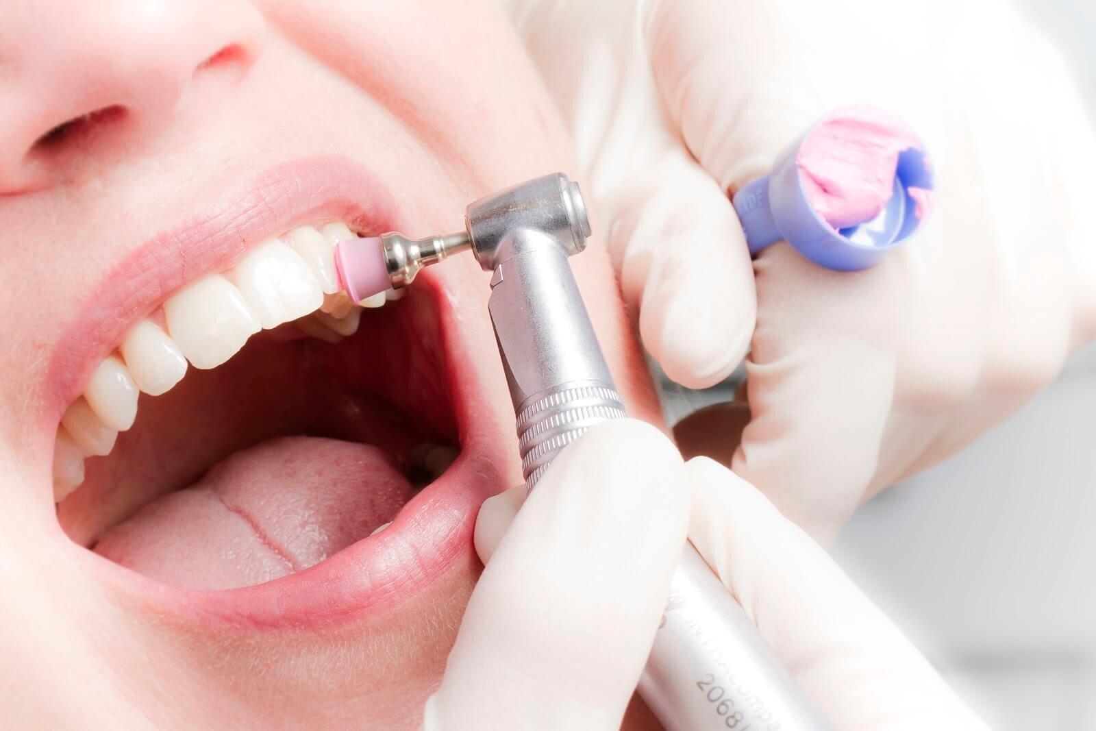 Работа ультразвуком в стоматологии
