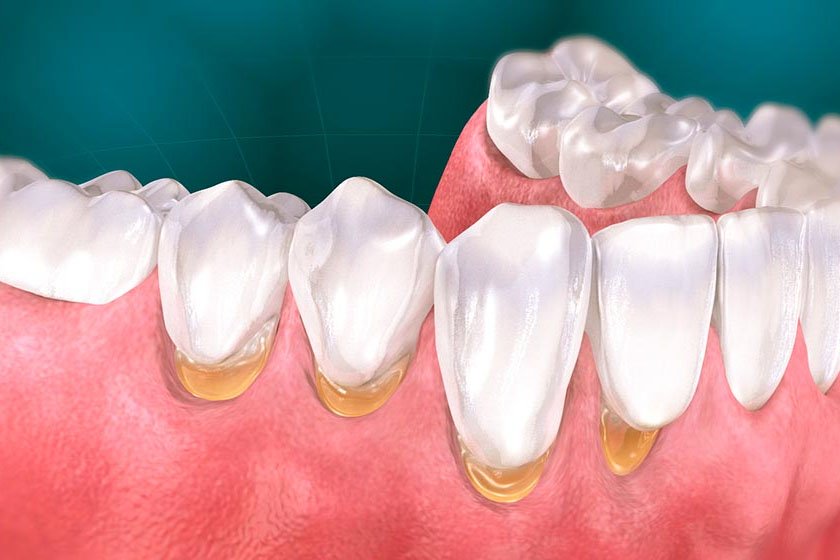 Важность диагностики некариозных поражений зубов