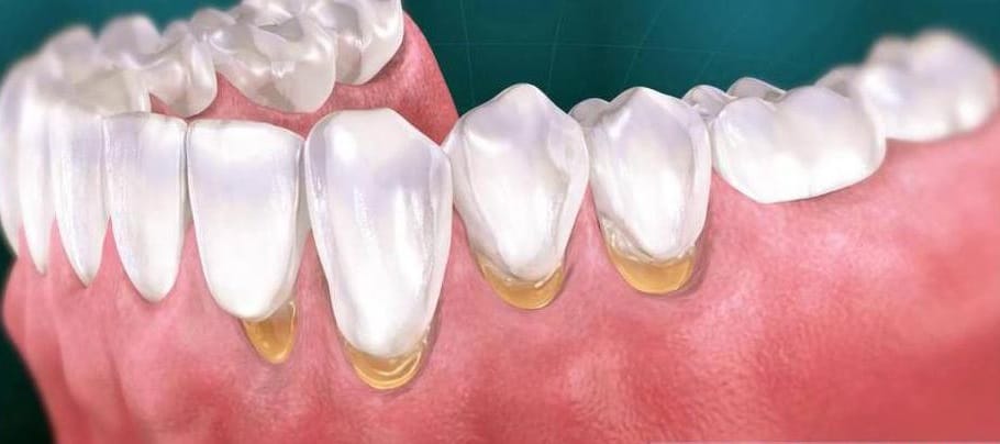 5 эффективных методов диагностики кариеса зубов