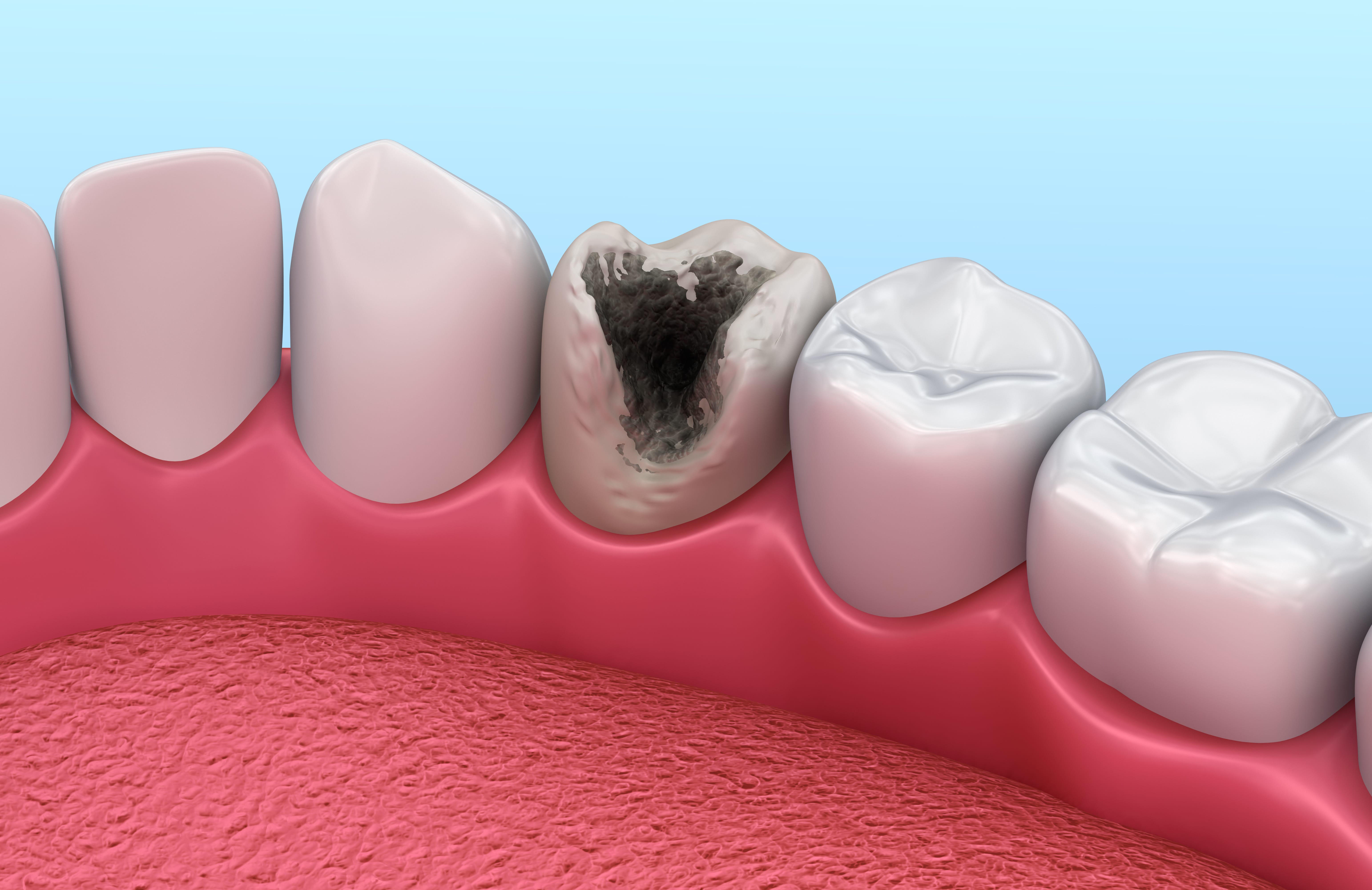Особенности лечения хронического пульпита зуба