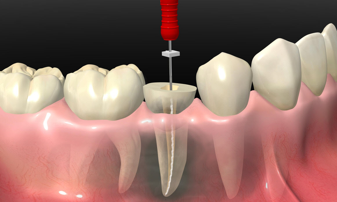 Методы лечения пульпита постоянных зубов